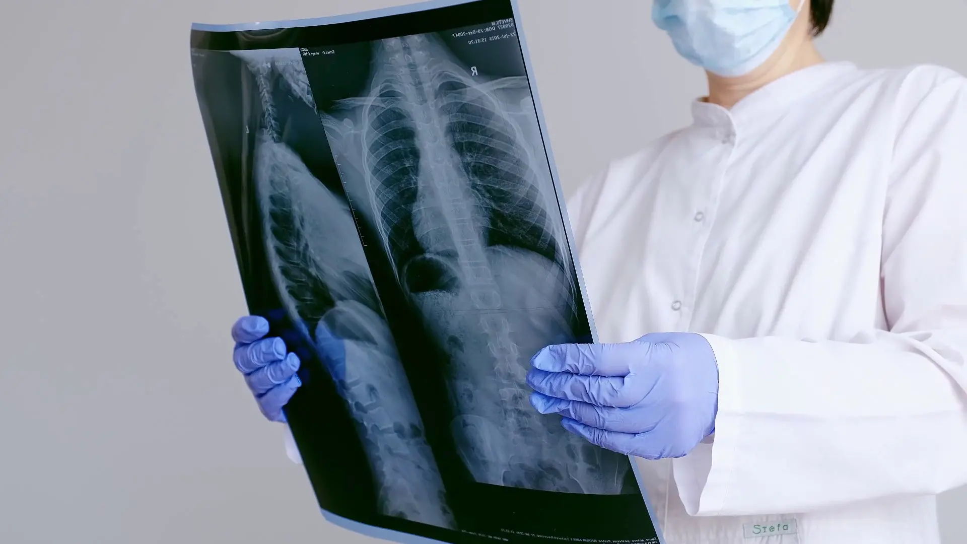 Tumori rari, i sarcomi richiedono diagnosi tempestive e alta specializzazione