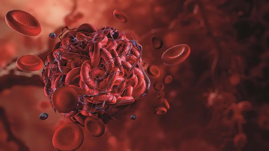 Trombosi, un paziente su tre può evitare le conseguenze, dall’infarto all’ictus