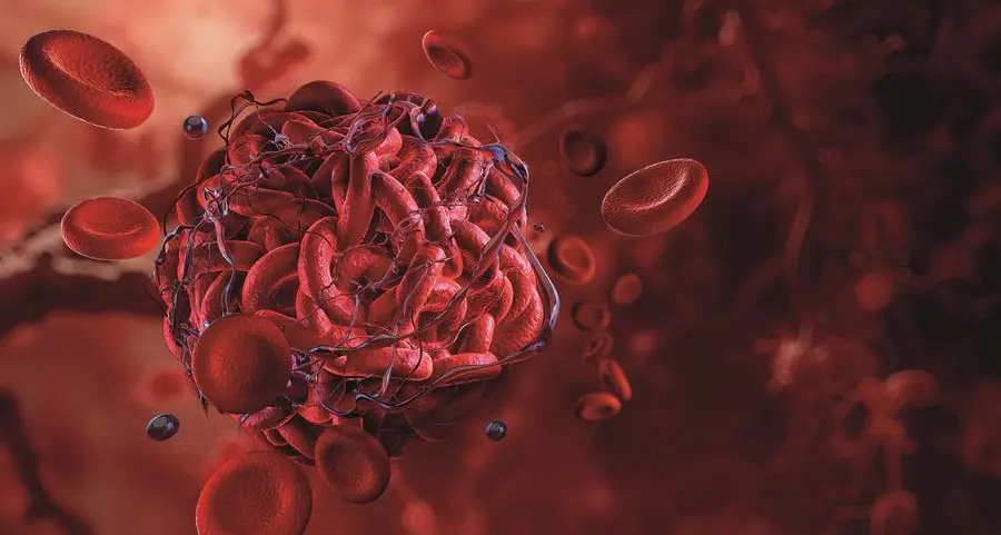 Trombosi, un paziente su tre può evitare le conseguenze, dall’infarto all’ictus