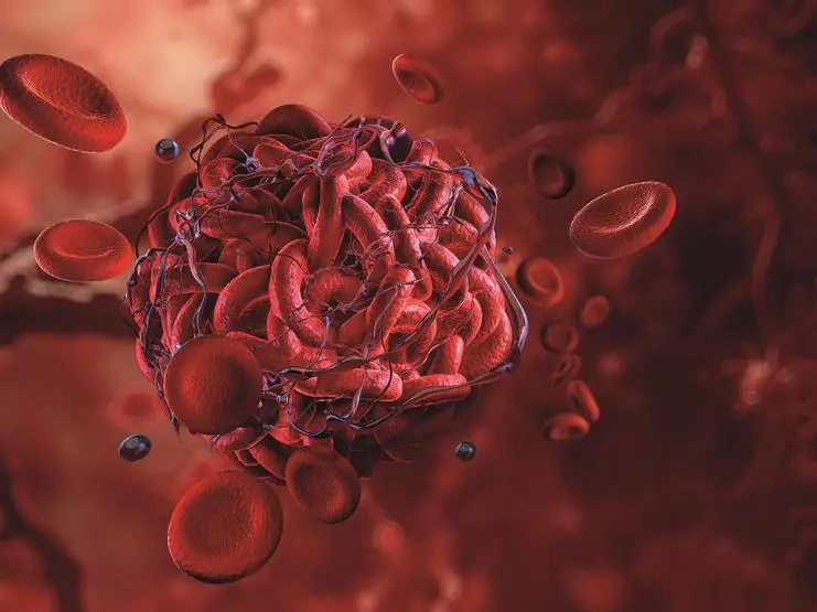 Trombosi, un paziente su tre può evitare le conseguenze, dall’infarto all’ictus