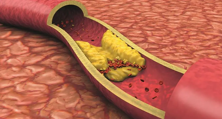 Un farmaco abbatte di sette volte i rischi di infarto e di ictus