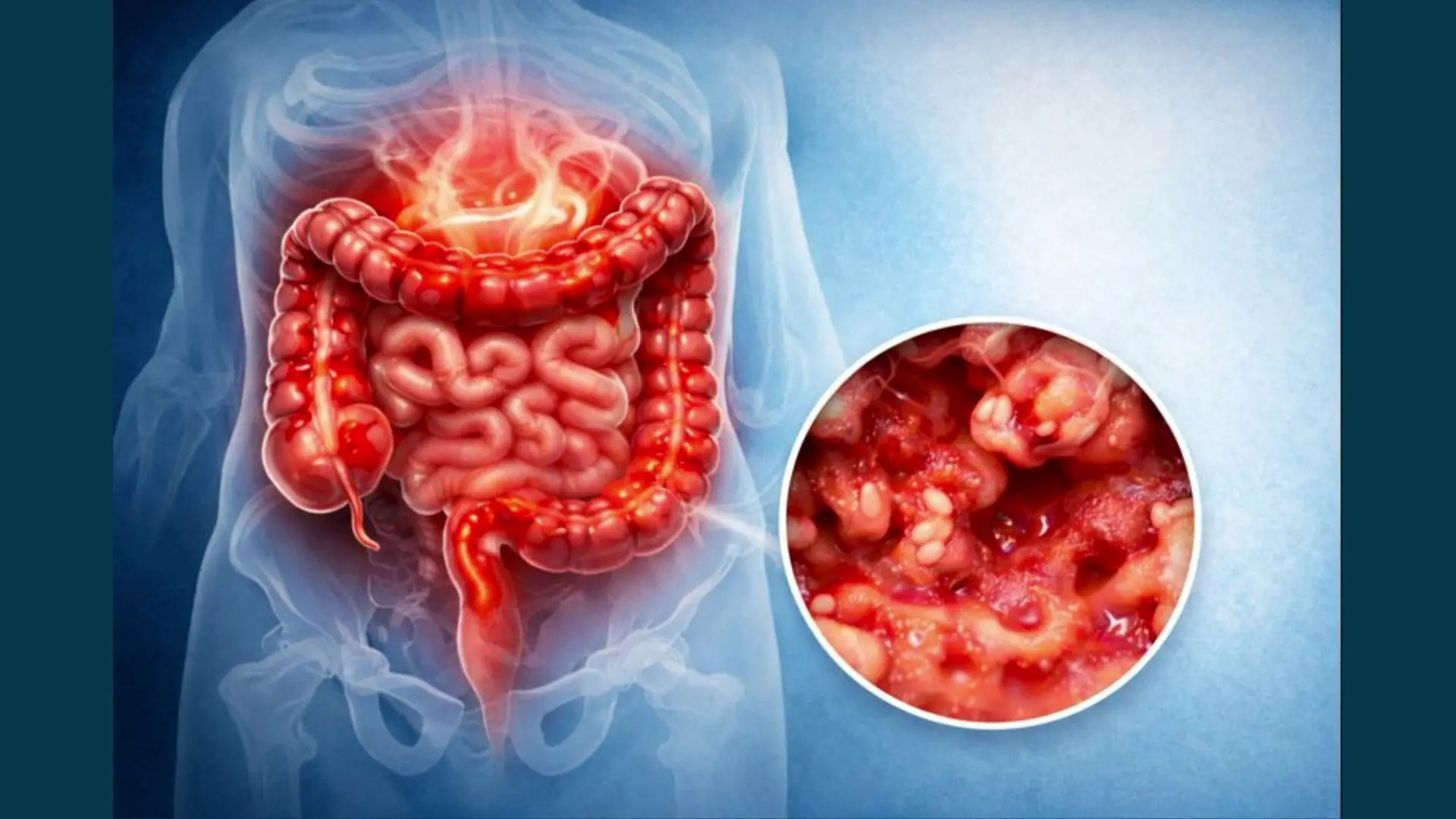 Colite ulcerosa, nuove opzioni terapeutiche