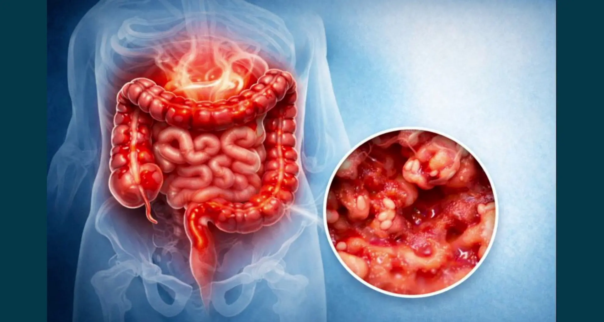 Colite ulcerosa, nuove opzioni terapeutiche