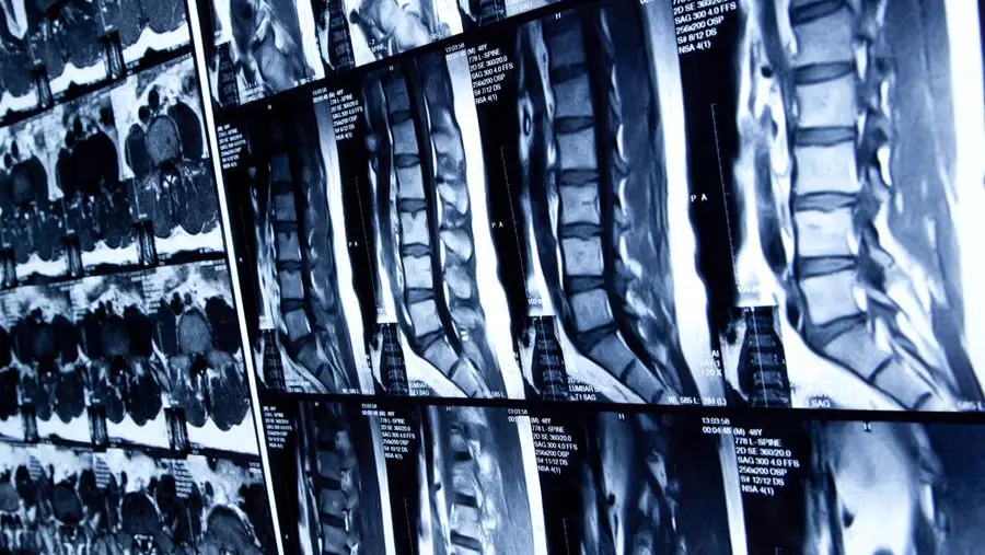 Spondiloartrite assiale: quale sport è consigliato?