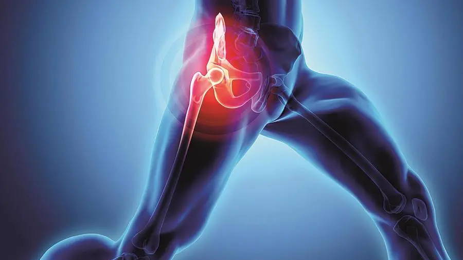 Artrosi dell’anca, come riconoscere i sintomi