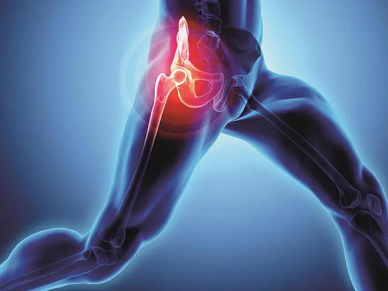 Artrosi dell’anca, come riconoscere i sintomi