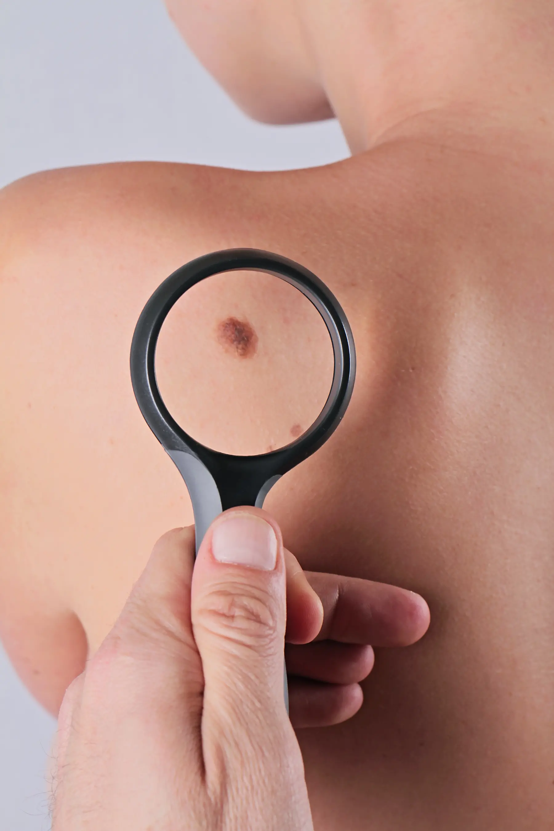 Melanoma, diagnosi e cure