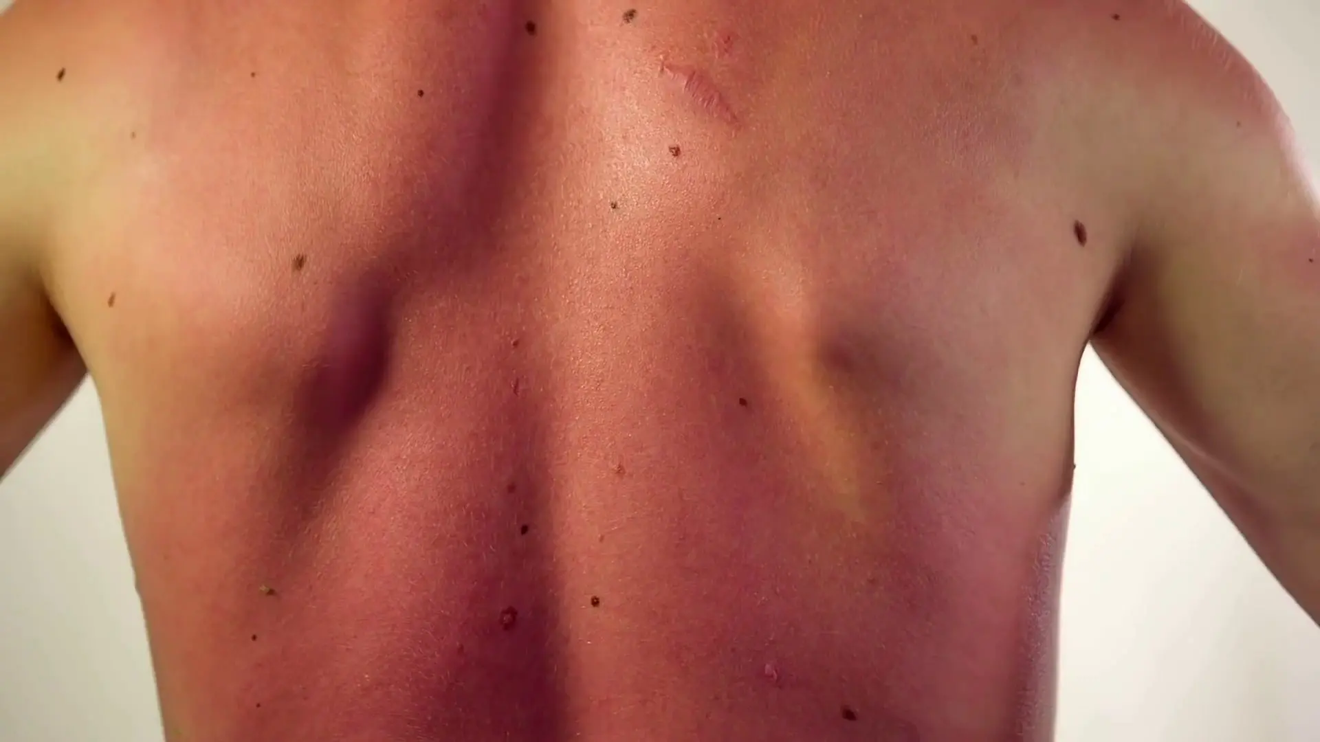 Tumori cutanei non melanoma, ecco cosa sono. E occhio all'esposizione al sole