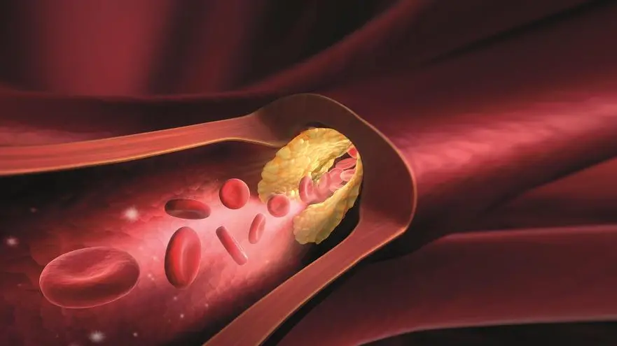 Colesterolo cattivissimo: l’importanza di misurare l’insidiosa e sconosciuta lipoproteina(a)