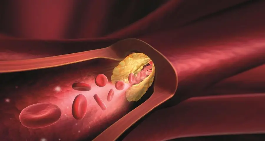 Colesterolo cattivissimo: l’importanza di misurare l’insidiosa e sconosciuta lipoproteina(a)