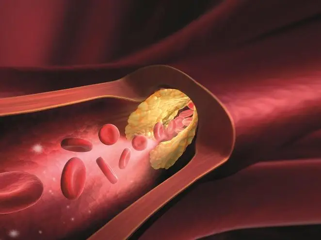Colesterolo cattivissimo: l’importanza di misurare l’insidiosa e sconosciuta lipoproteina(a)