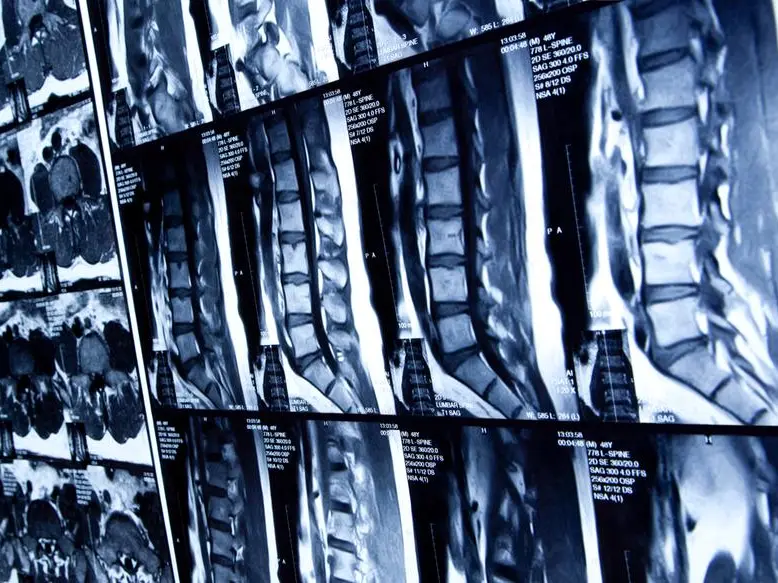 Cisti sinoviali: cause, sintomi, diagnosi e cure